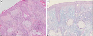 A) Hematoxilina-eosina (H-E, ×10). Áreas de vacuolización de la capa basal junto con exocitosis de células inflamatorias. B) Tinción azul alcián (×10). Epidermis adelgazada e incremento de mucina en la dermis.