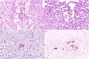 Imágenes de anatomía patológica. A) Sección histológica (H-E, x40) en la que se aprecia, en el centro de la imagen, una célula gigante multinucleada con células muriformes o cuerpos de Medlar en su interior. B) Sección histológica (H-E, x63) en la que se distinguen muy bien los cuerpos de Medlar en el centro de la imagen. C) Sección histológica (PAS, x40), en la que se observan de forma detallada los cuerpos de Medlar. D) Sección histológica (metenamina de plata, x40), en la que también se observan de forma detallada los cuerpos de Medlar.