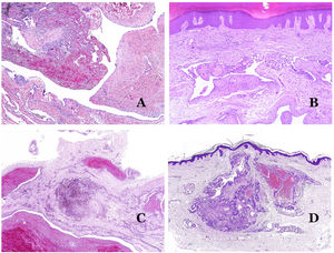(A) Venous malformation with a partially recanalized thrombus inside (hematoxylin–eosin ×40). (B) Venous malformation with endothelial papillary intravascular hyperplasia (hematoxylin–eosin ×40). (C) Venous malformation with hemosiderin deposits in an area of old hemorrhage (hematoxylin–eosin ×20). (D) In this example of glomuvenous malformation, dysmorphic veins are accompanied by irregularly distributed roundish monomorphous glomus cells (hematoxylin–eosin ×20).