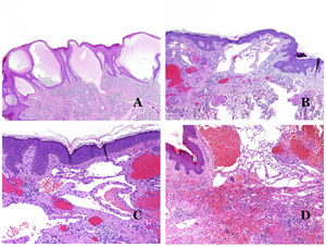 (A) Lymphatic malformation. The dysmorphic lymphatic vessel appears dilated in the papillary dermis. This presentation was named in the past as “circumscribed lymphangioma” (hematoxylin–eosin ×20). (B) Lymphatic malformation. Valves are evident in some of the dysmorphic lymphatic vessels (hematoxylin–eosin ×20). (C) Lymphatic malformation. Dysmorphic lymphatic vessels, some of them containing blood. A valve is also seen in one of the vessels. The stromal lymphocytic infiltrate is also a common feature (hematoxylin–eosin ×40). (D) Hemorrhagic area besides a lymphatic malformation. This is a frequent phenomenon due to the low resistance of the lymphatic wall to keep the blood inside the vessel. The long standing hemorrhages can sometimes lead to hemosiderotic deposits (hematoxylin–eosin ×20).