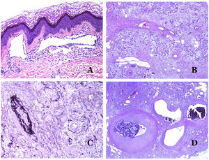 (A) Lymphatic malformation. An accompanying inflammatory lymphocytic infiltrate is a common finding in lymphatic malformations (hematoxylin–eosin ×100). (B) Arteriovenous malformation. In this type of malformation, some vessels are recognized as dysmorphic arteries, some as dysmorphic veins, and even some as having intermediate features between an artery and a vein (hematoxylin–eosin ×100). (C) Arteriovenous malformation. In this stain for elastic fibers, the dysmorphic artery (arrow) shows disruption of the internal elastic lamina. In comparison, a dysmorphic vein is shown in the same field (star) (orcein ×40). (D) Arteriovenous malformation. The dysmorphic veins appear enlarged with a thick fibrotic wall. One of the veins shows foreign material used for sclerosis in its lumen. Large areas of small proliferative blood vessels are also seen (hematoxylin–eosin ×20).