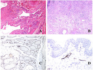 (A) Arteriovenous malformation (hematoxylin–eosin ×40). (B) Focus of vascular proliferative small vessels in an arteriovenous vascular malformation (hematoxylin–eosin ×40). (C) Venous malformation immunostained with CD31. The positive endothelia highlight the abnormal morphology of the dilated vessels (CD31 ×40). (D) Immunostaining for D2-40 showing positive endothelia in the lymphatics of the papillary dermis (D2-40 ×200).