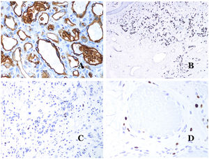 (A) Infantile hemangioma positive for GLUT-1. The positive endothelia are clearly evidenced. Positivity of the red cells is useful as a control (GLUT-1 ×400). (B) Immunoexpression of WT1 in an area of small proliferative blood vessels evidenced in an arteriovenous malformation (hematoxylin–eosin ×40). (C) The proliferative areas mainly seen in arteriovenous malformations are positive for Ki67 in a small number of endothelial nuclei (Ki67 ×200). (D) Vascular malformation. Immunostaining with Ki67. Endothelial cells are negative. Caution must be taken not to misread the surrounding positive cells (Ki67 ×400).