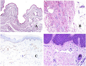 (A) Verrucous venous malformation. The malformed venules are mainly occupying the superficial dermis, although in most cases they extend deeply in the dermis and hypodermis, where they form nodular aggregates. The overlying epidermis appears verrucous and many times hypergranulotic and hyperkeratotic (orcein ×20). (B) Acquired progressive lymphatic anomaly. The image shows flattened malformed lymphatic vessels that permeate the whole dermis (hematoxylin–eosin ×100). (C) Acquired progressive lymphatic anomaly immunostained with D2-40. The endothelia are positive, showing the angulated and flattened shape of the vessels (D2-40 ×100). (D) Lymphatic vessel in the papillary dermis (hematoxylin–eosin ×200).