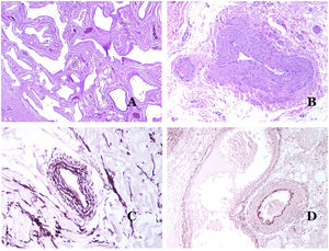 (A) Veins from the glans. At this location, the veins are specialized in collecting blood and appear dilated and organized in the corpus spongiosum. This should not be mistaken for a venous malformation (hematoxylin–eosin ×20). (B) Small vein with a continuous muscular layer (hematoxylin–eosin ×100). (C) Histochemical staining for elastic tissue showing the multiple concentrical discontinuous elastic bands evidenced in the muscular layer of a vein (orcein ×200). (D) Comparison between an artery (right) and a vein (left). The artery shows a thick wall when compared to the diameter of the vessel. In contrast, the vein (right) has a thinner wall. While a prominent internal elastic lamella is identified in the artery, it is not evident in veins. In contrast, veins have many discontinuous elastic fibers all over their wall (orcein ×20).