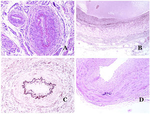 (A) Small artery in a skin biopsy. A prominent internal elastic lamella is evident even without special ancillary techniques (hematoxylin–eosin ×100). (B) This artery shows clear changes due to aging: the internal layer shows zonal thickening. The internal elastic lamella shows reduplication (orcein ×40). (C) Reduplication of the elastic internal lamella is a common phenomenon in aged arteries (orcein ×40). (D) Temporal artery showing a focus of calcification. Such foci are common with aging (hematoxylin–eosin ×100).