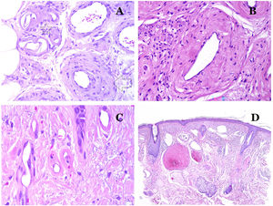 (A) This image shows changes in blood vessels due to aging. The arterioles show hyalinization of their wall (star) and a vein shows thickening of the muscular layer (arrow) (hematoxylin–eosin ×200). (B) Intimal fibrosis in a vein. This change is common with age (hematoxylin–eosin ×200). (C) Thickening of the basement membrane of capillaries, evidenced with aging (hematoxylin–eosin ×400). (D) Capillary-venous malformation. The dysmorphic capillaries appear dilated and in a haphazard distribution (hematoxylin–eosin ×20).