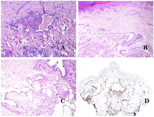 (A) Dysmorphic veins of a venous malformation. Veins appear irregular and angulated. Their walls show an irregular thickness with some areas in which the muscular layer is absent while it is thickened in others (hematoxylin–eosin ×100). (B) Venous malformation. The dysmorphic veins show great variation in their wall thickness. This is mainly due to the irregularities of the muscular layer thickness (hematoxylin–eosin ×40). (C) Venous malformation. The dysmorphic veins show an irregular wall with irregularities in their muscular layer: while muscle is thin or even lacking in some areas, it is hypertrophied in others. (D) Venous malformation. An immunostain for smooth muscle actin marks the irregular muscular layer of the dysmorphic veins (smooth muscle actin ×20).