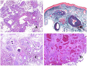 (A) Venous malformation. Dysmorphic veins are identified deep in the subcutaneous tissue (hematoxylin–eosin ×40). (B) Venous malformation. The dysmorphic veins show a muscular layer in which the muscles are divided in fascicles by collagen bundles, similar to what happens in normal veins (Masson trichrome ×20). (C) Venous malformation with a cluster arrangement of the dysmorphic veins (hematoxylin–eosin ×20). (D) Venous malformation with a back to back arrangement of the dysmorphic veins (hematoxylin–eosin ×20).