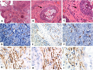 Histological and immunohistochemical (CD34) localization of the telocytes in normal skin. (A–C) Hematoxylin and eosin staining of the normal human skin, revealing unremarkable epidermis and dermal connective tissue. Within the dermal connective tissues, some spindle-shaped cells are finely distributed (arrows) throughout the dermis (original magnifications: A: ×40, B: ×200, C: ×400). (D–F) CD34 immunostain and the brown chromogendiaminobenzidine decorate the localization of several telocytes (TCs)/CD34-positive cells distributed throughout the dermis. The telocytes appear as spindle-shaped cells, having a nucleated oval or triangular cell body and thin, long, and varicose, moniliform tadpoles (original magnifications: D: ×400, E: ×400, F: ×600). (G–I) CD34-positive telocytes form an almost continuous layer around the basement membrane of the hair follicles (cells outer root sheath) and sebaceous glands (germinative layer) (original magnifications: G–I: ×1000, oil immersion).