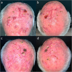 Imágenes clínicas de un paciente con un carcinoma epidermoide cutáneo multifocal localmente avanzado en el cuero cabelludo. (a y b) Antes del inicio de la inmunoterapia. (c y d) Remisión completa tras un ciclo de pembrolizumab 200mg cada 3 semanas. Persistencia de la remisión completa tras únicamente 3 ciclos de pembrolizumab y 21 meses sin tratamiento.