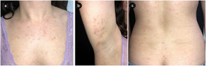 Características clínicas en el momento de la presentación: pápulas eritematosas de 2-4 mm, algunas de ellas costrosas, localizadas principalmente en el pecho (a), la superficie flexora del brazo derecho (b) y ligeramente en las nalgas (c).