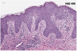 Hallazgos histológicos en la biopsia cutánea: espongiosis irregular con reacción liquenoide focal, edema dérmico papilar leve, extravasación de eritrocitos e infiltrado linfocitario perivascular; muy raramente se observan queratinocitos apoptóticos.