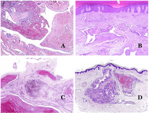A) Malformación venosa con un trombo parcialmente recanalizado en su interior (hematoxilina-eosina ×40). B) Malformación venosa con hiperplasia intravascular papilar endotelial (hematoxilina-eosina ×40). C) Malformación venosa con depósitos de hemosiderina en un área de hemorragia antigua (hematoxilina-eosina ×20). D) En este ejemplo de malformación glomovenosa, las venas dismórficas se acompañan de células glómicas monomorfas redondeadas distribuidas irregularmente (hematoxilina-eosina ×20).