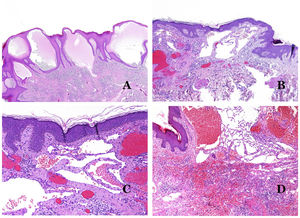 A) Malformación linfática. El vaso linfático dismórfico aparece dilatado en la dermis papilar. Esta presentación se denominó en el pasado como «linfangioma circunscrito» (hematoxilina-eosina ×20). B) Malformación linfática. Las válvulas son evidentes en algunos de los vasos linfáticos dismórficos (hematoxilina-eosina ×20). C) Malformación linfática. Vasos linfáticos dismórficos, algunos de ellos con sangre. También se ve una válvula en uno de los vasos. El infiltrado linfocítico estromal también es una característica común (hematoxilina-eosina ×40). D) Área hemorrágica además de una malformación linfática. Este es un fenómeno frecuente debido a la baja resistencia de la pared linfática para mantener la sangre dentro del vaso. Las hemorragias de larga duración a veces pueden dar lugar a depósitos hemosideróticos (hematoxilina-eosina ×20).
