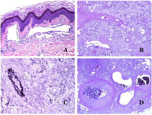 A) Malformación linfática. Un infiltrado linfocítico inflamatorio acompañante es un hallazgo común en las malformaciones linfáticas (hematoxilina-eosina ×100). B) Malformación arteriovenosa. En este tipo de malformación, algunos vasos se reconocen como arterias dismórficas, algunos como venas dismórficas e incluso algunos con características intermedias entre una arteria y una vena (hematoxilina-eosina ×100). C) Malformación arteriovenosa. En esta tinción para fibras elásticas, la arteria dismórfica (flecha) muestra rotura de la lámina elástica interna. En comparación, se muestra una vena dismórfica en el mismo campo (estrella) (orceína ×40). D) Malformación arteriovenosa. Las venas dismórficas aparecen agrandadas con una gruesa pared fibrótica. Una de las venas muestra material extraño utilizado para la esclerosis en su luz. También se observan grandes áreas de pequeños vasos sanguíneos proliferativos (hematoxilina-eosina ×20).