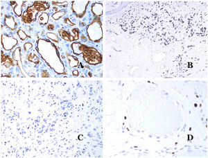A) Hemangioma infantil positivo para GLUT-1. Los endotelios positivos se evidencian claramente. La positividad de los glóbulos rojos es útil como control (GLUT-1 ×400). B) Inmunoexpresión de WT1 en un área de pequeños vasos sanguíneos proliferativos evidenciada en una malformación arteriovenosa (hematoxilina-eosina ×40). C) Las áreas proliferativas que se observan principalmente en las malformaciones arteriovenosas son positivas para Ki-67 en un pequeño número de núcleos endoteliales (Ki67 ×200). D) Malformación vascular. Inmunotinción con Ki67. Las células endoteliales son negativas. Se debe de tener cuidado de no leer mal las celdas positivas circundantes (Ki-67 ×400).