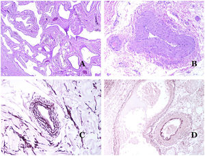 A) Venas del glande. En este lugar, las venas se especializan en recolectar sangre y aparecen dilatadas y organizadas en el cuerpo esponjoso. Esto no debe confundirse con una malformación venosa (hematoxilina-eosina ×20). B) Pequeña vena con una capa muscular continua (hematoxilina-eosina ×100). C) Tinción histoquímica para tejido elástico que muestra las múltiples bandas elásticas discontinuas concéntricas evidenciadas en la capa muscular de una vena (orceína ×200). D) Comparación entre una arteria (derecha) y una vena (izquierda). La arteria muestra una pared gruesa en comparación con el diámetro del vaso. Por el contrario, la vena (derecha) tiene una pared más delgada. Si bien se identifica una laminilla elástica interna prominente en la arteria, no es evidente en las venas. En cambio, las venas tienen muchas fibras elásticas discontinuas en toda su pared (orceína ×20).