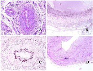 A) Pequeña arteria en una biopsia de piel. Es evidente una lámina elástica interna prominente incluso sin técnicas auxiliares especiales (hematoxilina-eosina ×100). B) Esta arteria muestra cambios claros debido al envejecimiento: la capa interna muestra un engrosamiento zonal. La lámina elástica interna muestra reduplicación (orceína ×40). C) La reduplicación de la lámina interna elástica es un fenómeno común en las arterias envejecidas (orceína ×40). D) Arteria temporal que muestra un foco de calcificación. Dichos focos son comunes con el envejecimiento (hematoxilina-eosina ×100).