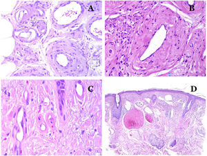 A) Esta imagen muestra cambios en los vasos sanguíneos debido al envejecimiento. Las arteriolas muestran hialinización de su pared (estrella) y una vena muestra engrosamiento de la capa muscular (flecha) (hematoxilina-eosina ×200). B) Fibrosis íntima en una vena. Este cambio es común con la edad (hematoxilina-eosina ×200). C) Engrosamiento de la membrana basal de los capilares, evidenciado con el envejecimiento (hematoxilina-eosina ×400). D) Malformación capilar-venosa. Los capilares dismórficos aparecen dilatados y en una distribución desordenada (hematoxilina-eosina ×20).