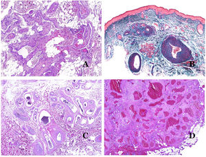 A) Malformación venosa. Las venas dismórficas se identifican en lo profundo del tejido subcutáneo (hematoxilina-eosina ×40). B) Malformación venosa. Las venas dismórficas muestran una capa muscular en la que los músculos están divididos en fascículos por haces de colágeno, similar a lo que ocurre en las venas normales (tricrómico de Masson ×20). C) Malformación venosa con disposición en racimo de las venas dismórficas (hematoxilina-eosina ×20). D) Malformación venosa con disposición contigua de las venas dismórficas (hematoxilina-eosina ×20).