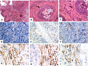 Localización histológica e inmunohistoquímica (CD34) de los telocitos en la piel normal. (A-C) Tinción con hematoxilina y eosina de la piel humana normal, que revela una epidermis y un tejido conjuntivo dérmico anodinos. Dentro de los tejidos conectivos dérmicos, algunas células fusiformes están finamente distribuidas (flechas) por toda la dermis (aumentos originales: A: ×40, B: ×200, C: ×400). (D–F) La inmunotinción CD34 y la cromogendiaminobencidina marrón decoran la localización de varios telocitos (TC)/células positivas para CD34 distribuidas por toda la dermis. Los telocitos aparecen como células fusiformes, con un cuerpo celular nucleado de forma ovalada o triangular y proyecciones largas, delgadas, moniliformes, y tortuosas (aumentos originales: D: ×400, E: ×400, F: ×600). (G–I) Los telocitos positivos para CD34 forman una capa casi continua alrededor de la membrana basal de los folículos pilosos (vaina externa de la raíz de las células) y las glándulas sebáceas (capa germinativa) (aumentos originales: G–I: ×1000, inmersión en aceite).