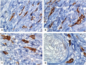 Localización inmunohistoquímica de los telocitos en la piel humana normal usando CD117 (C-KIT). (A–D) Los telocitos en forma de huso (TC) se tiñen con CD117 y la cromogendiaminobencidina marrón. Los TC se pueden separar fácilmente de las otras células estromales circundantes. Los TC tienen una apariencia alargada con núcleos ovalados o triangulares (contrateñidos con hematoxilina de Mayer) y largas proyecciones tortuosas similares a renacuajos que se extienden desde sus cuerpos celulares (aumento original, ×1000, inmersión en aceite).