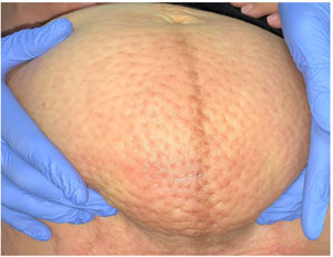 Infraumbilical edematous plaque, with an orange peel appearance and well-defined borders.