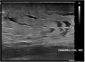 Soft tissue ultrasound. Note the accumulation of fluid in the area, seen as linear anechoic tracts.