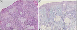 (A) Hematoxylin–eosin, ×10. Areas of vacuolization of the basal layer, together with exocytosis of inflammatory cells. (B) Alcian blue staining (×10). Thinned epidermis and increased mucin in the dermis.
