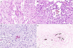 Histopathology findings. A, Histologic section (hematoxylin–eosin, ×40). Note the multinucleate giant cell in the center of the image, with Medlar bodies (muriform cells) in the interior. B, Histologic section (hematoxylin–eosin, ×63). The Medlar bodies are clearly visible in the center of the image. C, Histologic section (periodic acid–Schiff, ×40) showing detail of the Medlar bodies. D, Histologic section (methenamine silver, ×40) showing detail of the Medlar bodies.