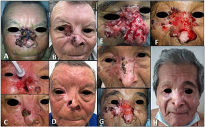 A, Tumor before initiation of vismodegib. B, Partial response in the region of the nasal dorsum and cheek, but progression to the inner canthus of the right eye. C, Tumor cytoreduction with local destructive methods. D, Complete response sustained for 36 months after radiotherapy. E, Tumor before initiation of targeted therapy with vismodegib. F, Increased tumor volume on the wings of the nose and inner canthus after 13 cycles. G, Results after curettage-electrodessication in larger tumor areas and cryosurgery on the wings of the nose. H, Complete remission sustained for 15 months after discontinuation of vismodegib and 33 months after radiotherapy.