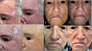 A, Tumor before local resection by ocular oncology department at the level of the canthus and eyelid. B, Residual tumor with biopsy-proven positive margins in the left temporal and eyelid region before initiation of vismodegib. C, Complete clinical response after 8 cycles of vismodegib and initiation of external beam radiotherapy. D, Complete remission sustained after 30 months of follow-up. E, Tumor before treatment with vismodegib. F, Complete response after 3 cycles. G, Complete response after 8 cycles and prior to radiotherapy. H, Complete remission after radiotherapy and 34 months of follow-up.