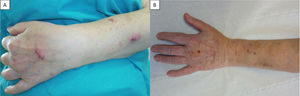 A. Dos nódulos eritematosos infiltrados de distribución esporotricoide en el dorso de la mano y en el antebrazo izquierdo. B. Resolución de las lesiones tras el tratamiento.