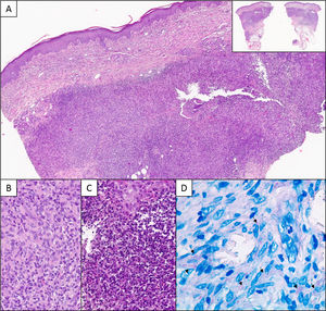 A. Corte histológico que muestra un infiltrado dérmico profundo granulomatoso de patrón nodular (detalle panorámico en la esquina superior derecha) (H-E 40×). B. Detalle del infiltrado, constituido por linfocitos e histiocitos (H-E 200×). C. Áreas supurativas con abundantes neutrófilos y restos celulares (H-E 400×) D. Técnica histoquímica de Ziehl-Neelsen. Flechas señalando estructuras alargadas de color rosa (630×).