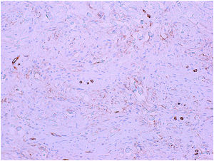 Inmunohistoquímica CD34, ×200.
