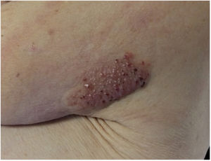 Primera consulta. Hombro izquierdo: placa de 8 × 5cm, rojo-violácea, con superficie pseudovesicular y arracimada.