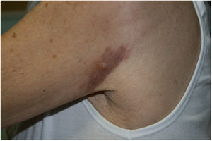 Revisión. Hombro izquierdo: mácula eritematoviolácea residual, con única vesícula en el centro.