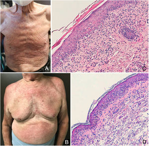 A) Eritrodermia con afectación de la zona anterior del tronco en el primer paciente. B) Rash maculopapular eritematoso con afectación de la zona anterior de tronco y áreas laterales de hombros y brazos en el segundo paciente. C y D) Biopsias cutáneas realizadas en las zonas pectorales de ambos pacientes, en las que se observa un infiltrado predominantemente linfocitario en dermis superficial, asociado a daño de interfase prominente y abundantes queratinocitos apoptóticos (hematoxilina-eosina, x200).