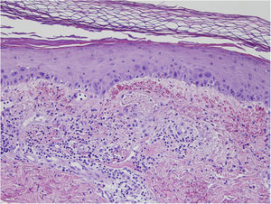 Capa córnea ortoqueratósica, con atipia de queratinocitos en epidermis y extravasación hemática marcada. Leve infiltrado linfomonocitario perivascular superficial.