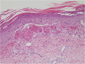 Capa córnea hiperqueratósica con atipia en la epidermis, extravasación hemática y edema en dermis papilar.
