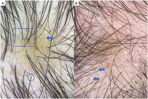 Alopecia androgenética (AGA). A) Heterogeneidad del grosor del tallo piloso o anisotricosis (cuadrado), signo marrón peripilar (flechas), signo blanco peripilar (círculos). B) Signos tricosópicos de AGA con descamación gruesa interfolicular (flecha) por dermatitis seborreica asociada.