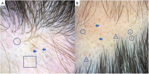 Alopecia areata. A) Pelos en signo de exclamación (círculos), pelos vellosos (cuadrado) y pelos en recrecimiento (flechas). B) Puntos negros (triángulos), pelos rotos (círculos) y pelos vellosos (flechas).
