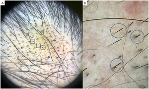 Tricotilomanía. A) Puntos negros (flechas), pelos enroscados o en forma de gancho (círculo) y pelos rotos a distintas longitudes (cuadrados). B) Detalle de tricoptilosis (tallos de longitud variable con puntas deshilachadas o abiertas) o pelos en tulipán (círculos).