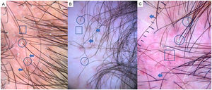 A) Liquen plano pilar: ausencia de aperturas foliculares (flechas), hiperqueratosis y eritema perifolicular (círculos) y puntos blancos (cuadrado). B) Alopecia frontal fibrosante: eritema e hiperqueratosis concéntrica perifolicular (círculos), ausencia de orificios foliculares (cuadrado), pérdida de pelos vellosos y pili torti like (flechas). C) Alopecia fibrosante en patrón androgenético (FAPD): eritema e hiperqueratosis perifolicular (círculos), anisotricosis (cuadrado), miniaturización, pelos vellosos y áreas cicatriciales con atriquia focal (cuadrado).
