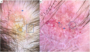Lupus discoide. A) Ausencia de orificios foliculares, tapones córneos o puntos amarillos gigantes (círculo), hiperqueratosis perifolicular grosera (cuadrado) y patrones vasculares aberrantes: capilares gigantes, vasos arboriformes gruesos y telangiectasias finas (flecha). B) Detalle de tapones córneos (círculos) y vasos arboriformes gruesos (flechas).