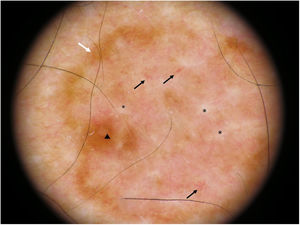 Imagen dermatoscópica. Foco de pigmentación excéntrico (triángulo), retículo típico en periferia (flecha blanca), centro desestructurado con disrupción completa del retículo y líneas blancas (asterisco) y fondo eritematoso con vascularización atípica (flecha negra).