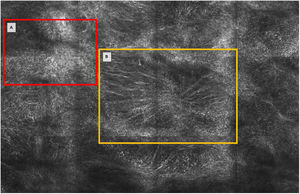 Microscopía confocal. A) Epidermis con numerosas células dendríticas. B) Engrosamientos junturales y células dendríticas en la unión dermoepidérmica.