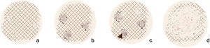 Modelo de progresión dermatoscópica del lentigo maligno extrafacial adaptado de Gamo-Villegas, et al.2 a) Disrupción del retículo. b) Áreas borradas y estructuras triangulares. c) Líneas anguladas y en zigzag. d) Extensas áreas.