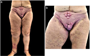 Metástasis cutánea de adenocarcinoma gástrico.